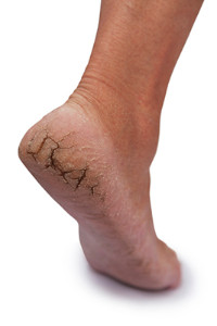 Cracked skin on heels of feet deals