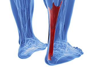 Achilles Tendonitis Treatment in the Wayne, NJ 07470 and Caldwell, NJ 07006 area