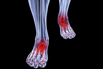 Arthritic foot and ankle care treatment in the Wayne, NJ 07470 and Caldwell, NJ 07006 areas