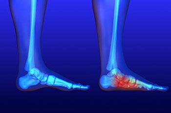 Flat Feet Treatment in the Wayne, NJ 07470 and Caldwell, NJ 07006 areas