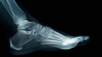 Foot and Ankle Fractures: Symptoms, Diagnosis and Treatment in the Wayne, NJ 07470 and Caldwell, NJ 07006