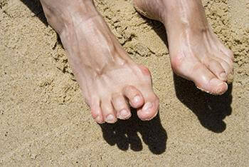 Hammertoes specialist in the Wayne, NJ 07470 and Caldwell, NJ 07006 area