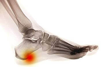 heel spur treatment in the Wayne, NJ 07470 and Caldwell, NJ 07006 area