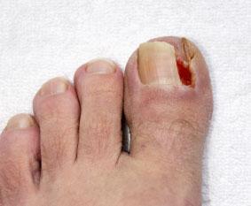 Painful thickened toenails — Mackay Ingrown Toenail Clinic