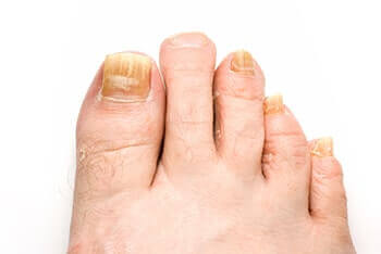 toenail fungus treatment in the Wayne, NJ 07470 and Caldwell, NJ 07006 areas