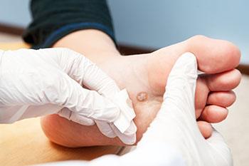 Plantar Warts Treatment in the 
Caldwell, NJ 07006 and Wayne, NJ 07470 areas