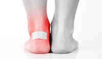 What Can Cause a Foot Blister?