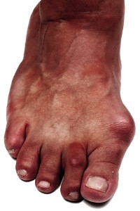 Symptoms and Causes of Bunions