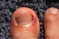 What are the Causes of an Ingrown Toenail?