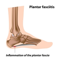 How Does Plantar Fasciitis Develop?