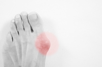 Different Reasons a Bunion May Develop